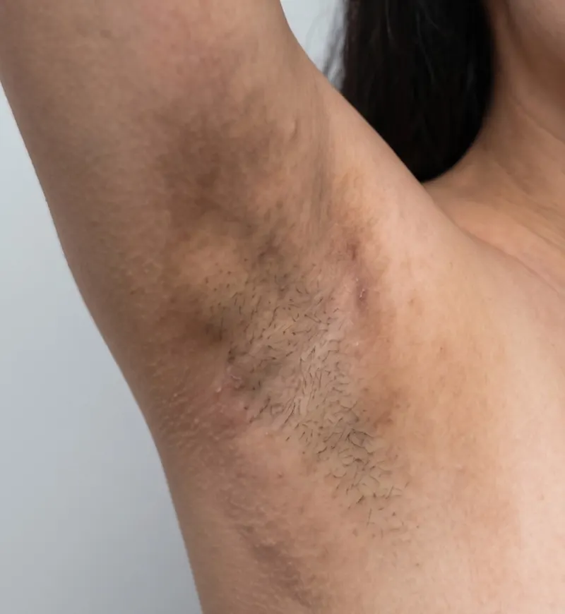 Before — Laser hair removal — underarm before and after a 6-session course